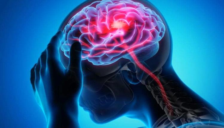لماذا تكون آثار السكتة الدماغية أشد لدى البعض؟