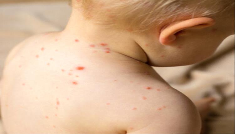 أعراض الحصبة لدى الأطفال.. تعرف عليها