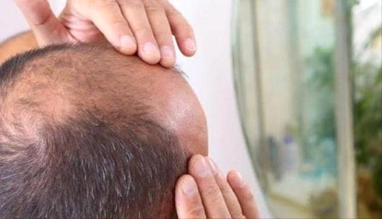 أول علاج مبتكر للصلع الذكوري منذ 30 عامًا: نتائج مذهلة لدواء "كلاسكوتيرون"