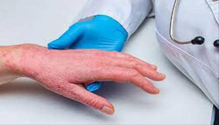 أول إصابة بسلالة "إمبوكس 1ب" في برلين