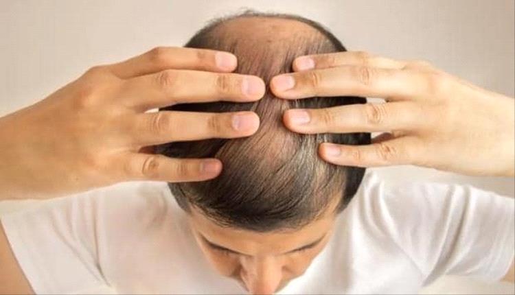 علاج واعد للصلع يحقق نتائج مذهلة
