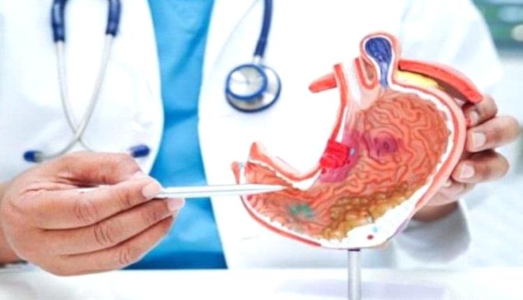 احذر هذه الأطعمة تسبب قرحة في المعدة