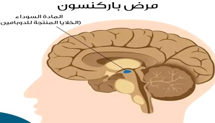 استخدام الذكاء الاصطناعي لتشخيص مرض شهير يصيب كبار السن