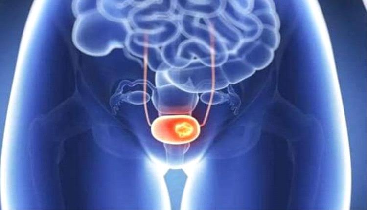 علاج ثوري يقضي على سرطان المثانة: نجاح باهر في 82% من الحالات