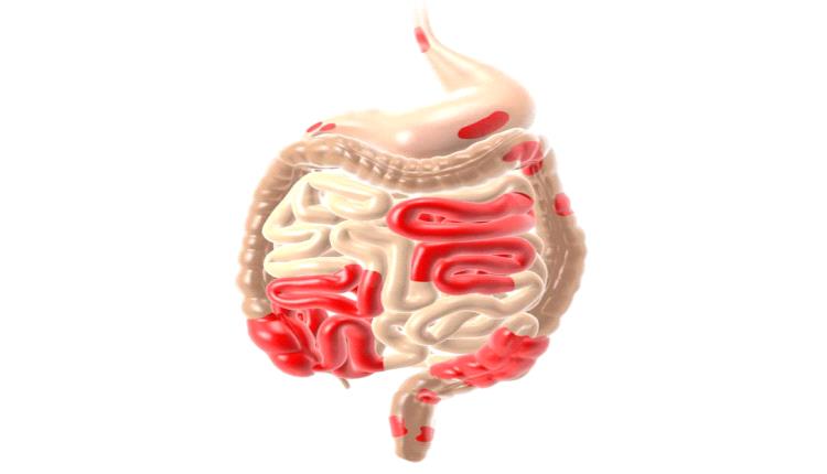داء كرون: مرض الجهاز الهضمي المزمن وأعراضه الرئيسية