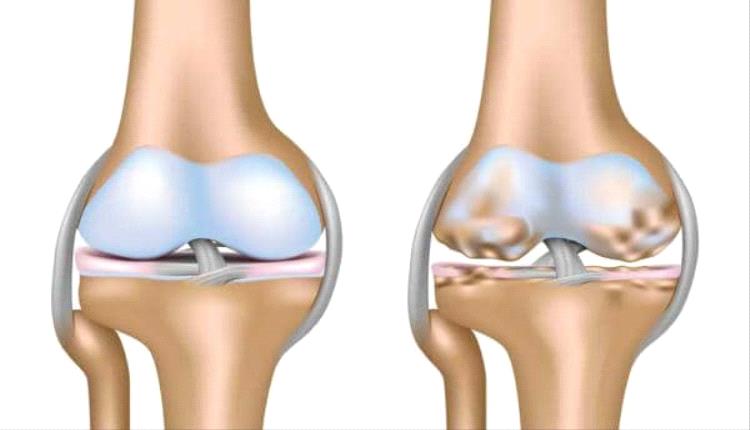 دراسة تكشف فروقًا "مدهشة" في إصابات الركبة بين الرجال والنساء
