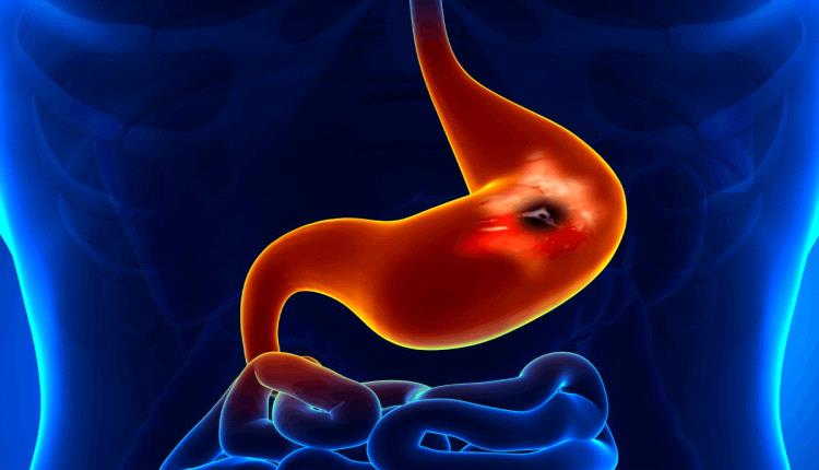 تحذيرات صحية من أطعمة تزيد خطر قرحة المعدة ودعوات لتعديل العادات الغذائية