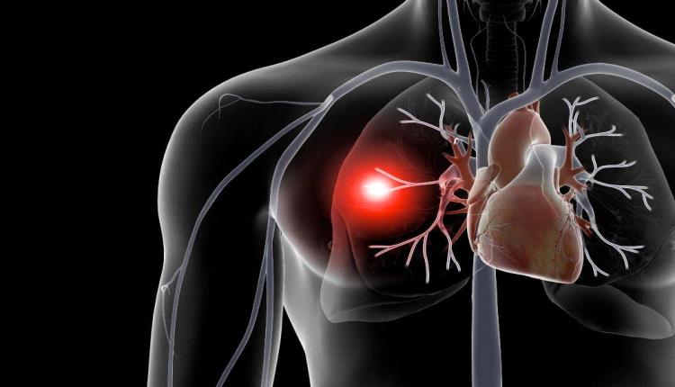 تقنية طبية متقدمة تقلل فقدان الدم بنسبة 97% أثناء إزالة الجلطات الرئوية