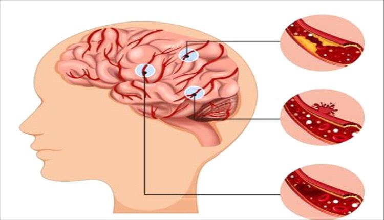 سكتة دماغية “صامتة” قد تضرب كل 40 ثانية.. 7 مؤشرات مبكرة تكشف الخطر قبل وقوع الكارثة