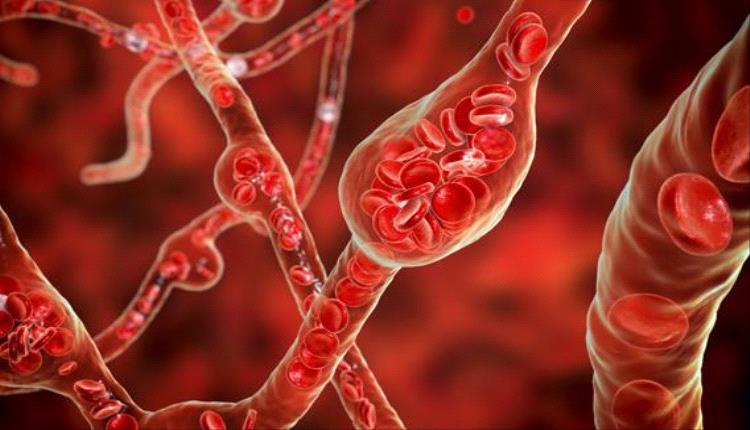 ابتكار جهاز حيوي مرن بتقنية ثلاثية الأبعاد لعلاج ضغط الدم المقاوم للأدوية